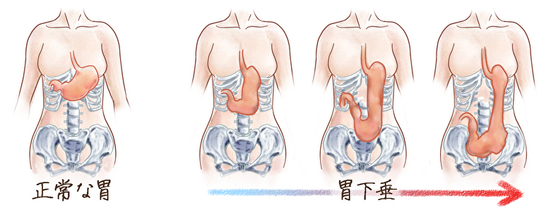 内臓下垂